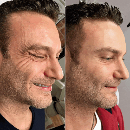 Botox Before and Afters